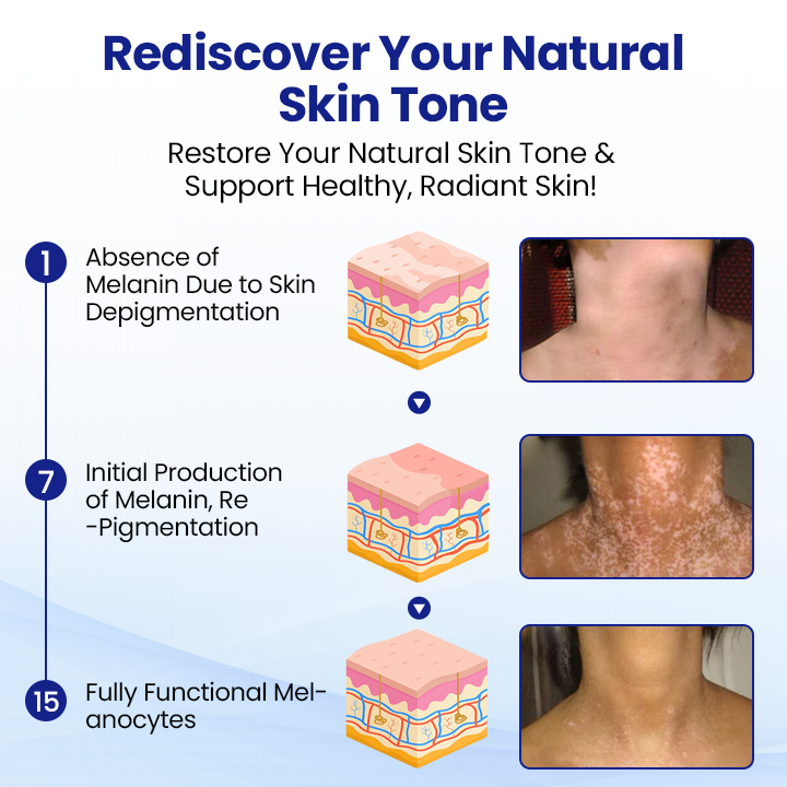 BalanceVie Vitiligo | Botanical Vitiligo Repigmentation Spray USA
