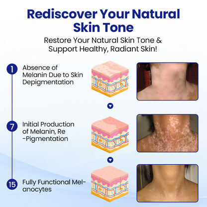 BalanceVie Vitiligo | Botanical Vitiligo Repigmentation Spray USA