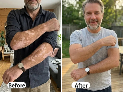 BalanceVie Vitiligo | Botanical Vitiligo Repigmentation Spray Canada