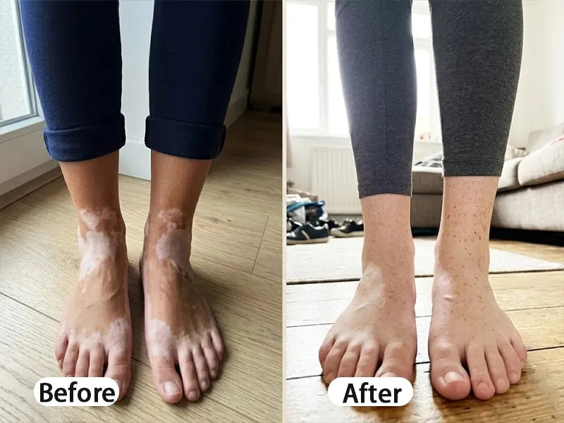 BalanceVie Vitiligo | Botanical Vitiligo Repigmentation Spray Canada