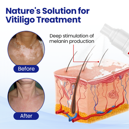 BalanceVie Vitiligo | Botanical Vitiligo Repigmentation Spray USA