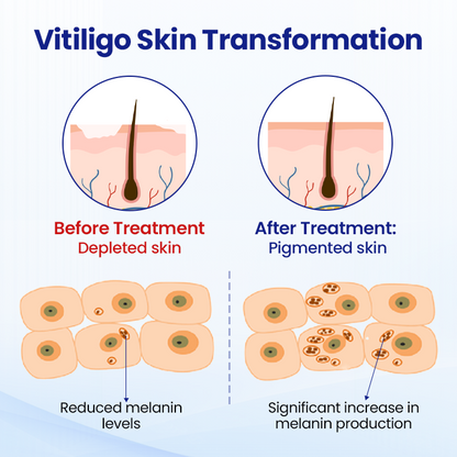 BalanceVie Vitiligo | Botanical Vitiligo Repigmentation Spray USA