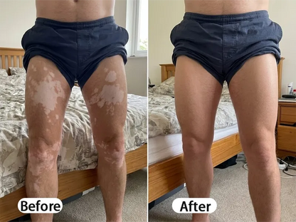 BalanceVie Vitiligo | Botanical Vitiligo Repigmentation Spray Canada