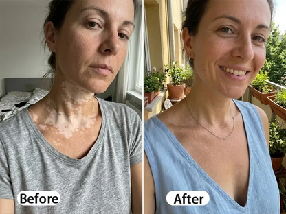 BalanceVie Vitiligo | Botanical Vitiligo Repigmentation Spray Canada